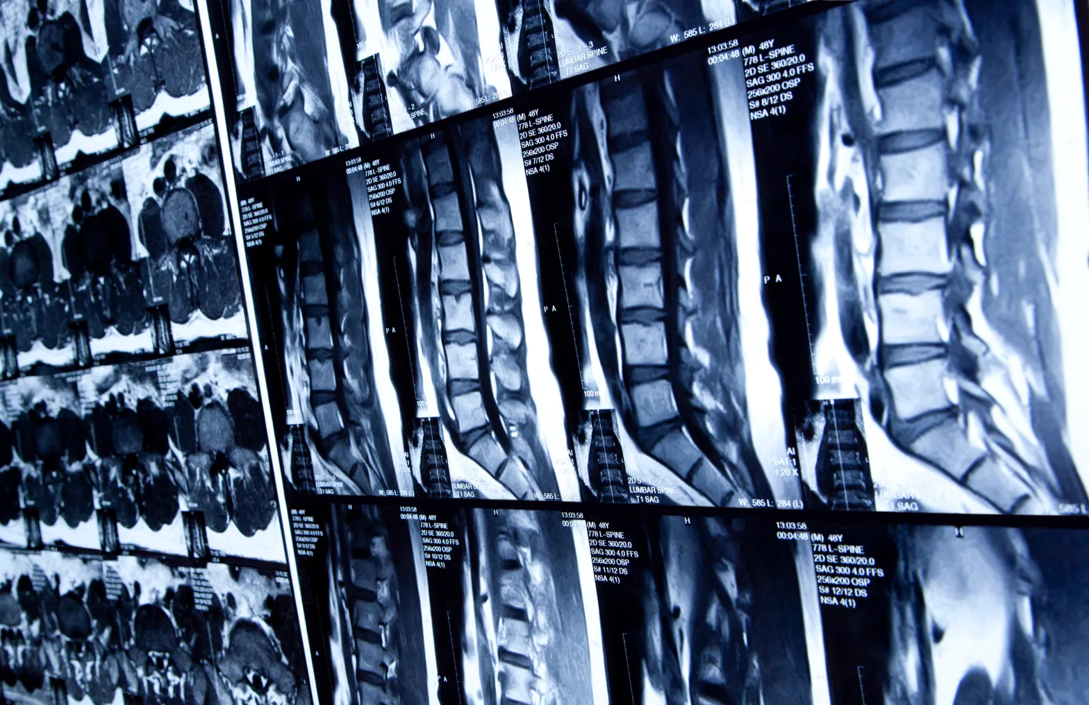 Multiple black-and-white scans of the lumbar spine next to each other.