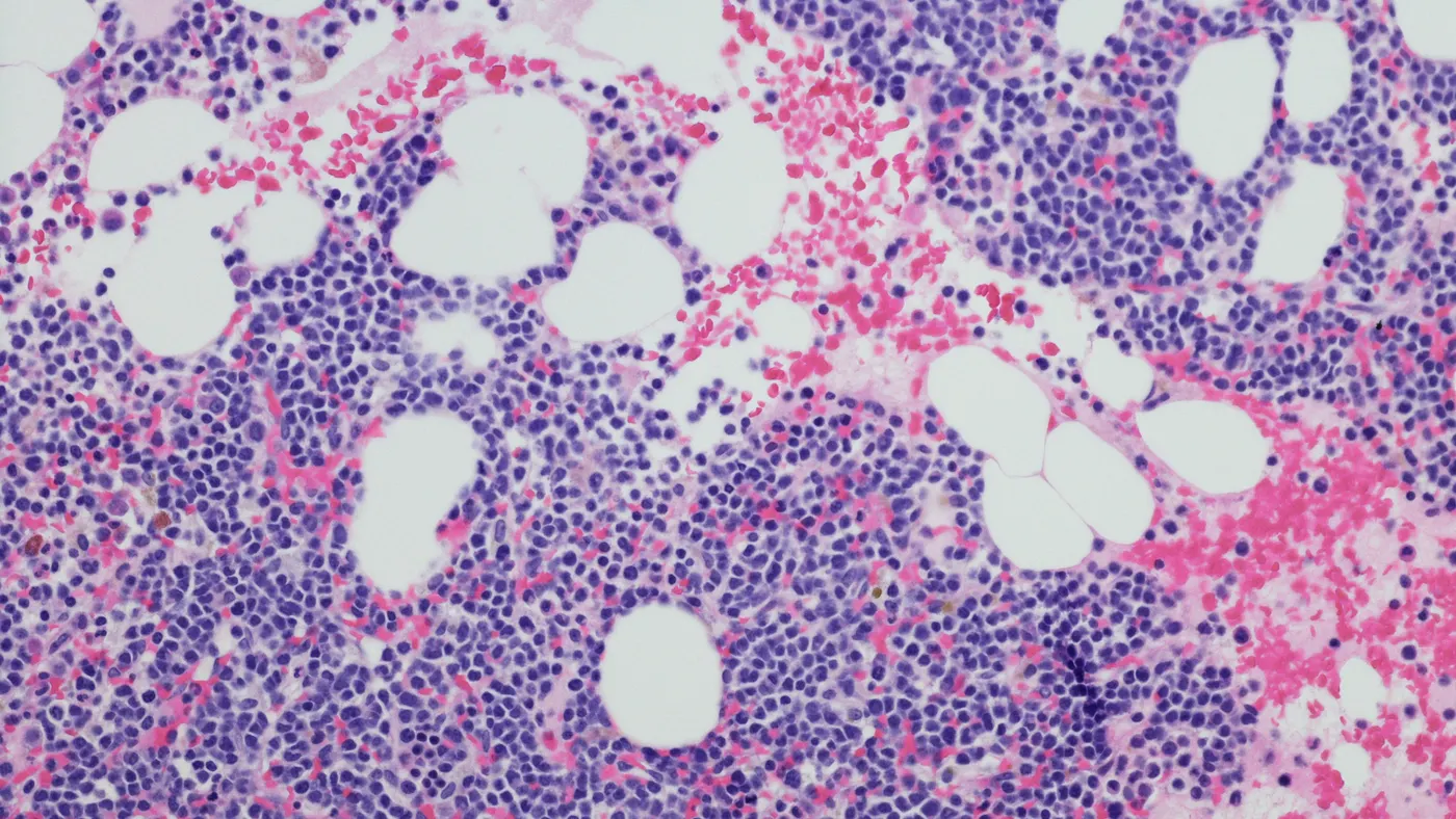A micrograph of a myeloma neoplasm in a bone marrow biopsy.