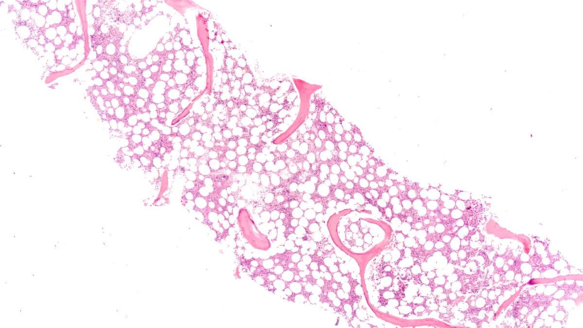 A micrograph showing a bone marrow biopsy