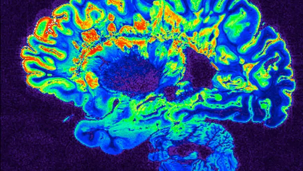 This is a pseudo-colored image of high-resolution gradient-echo MRI scan of a fixed cerebral hemisphere from a person with multiple sclerosis.