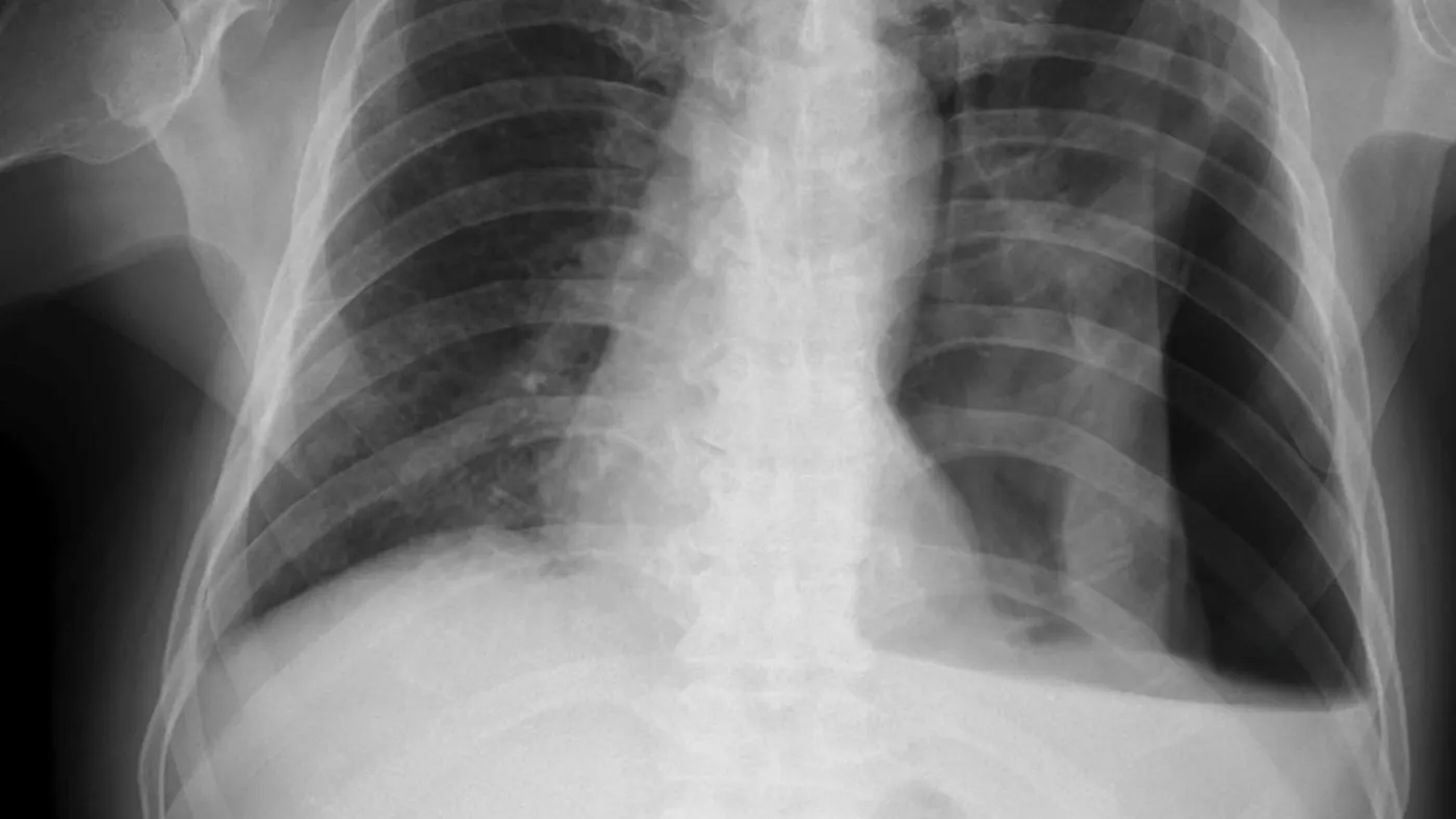 An X-ray image shows the lungs and the ribcage