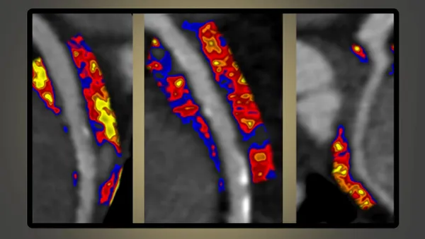 Caristo Diagnostics' CaRi-Heart technology shown on a screen.