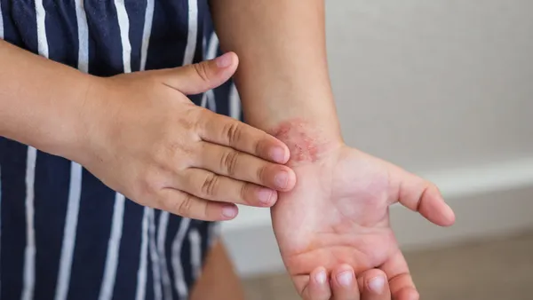 A close-up of a child's hands with red, irritated skin on the wrist.