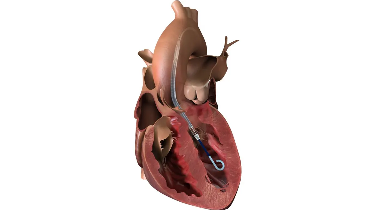 Johnson & Johnson's Impella CP heart pump is shown in an illustration of the heart.