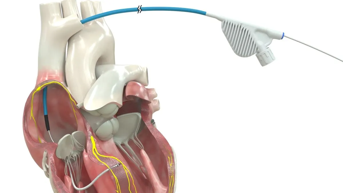 An illustration of the Medtronic OmniaSecure defibrillation lead in the heart.