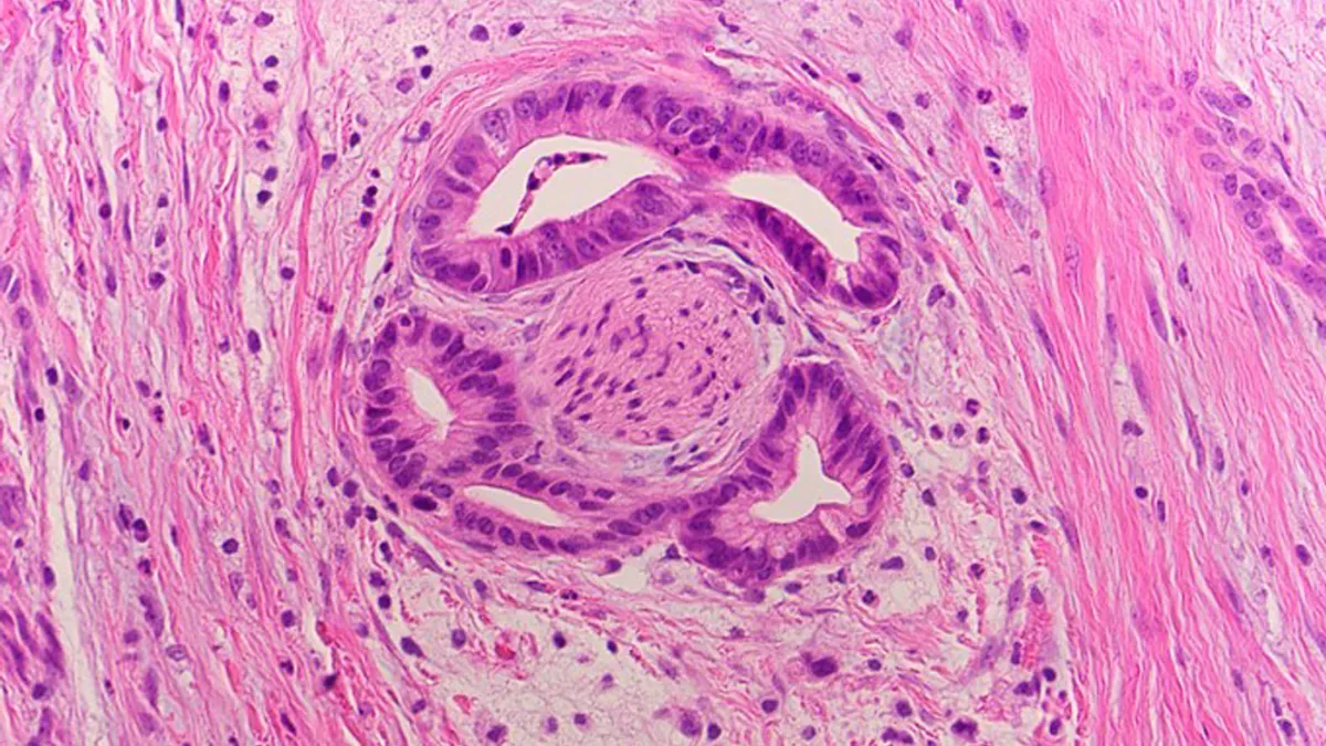 A tissue slide of a cancer specimen.