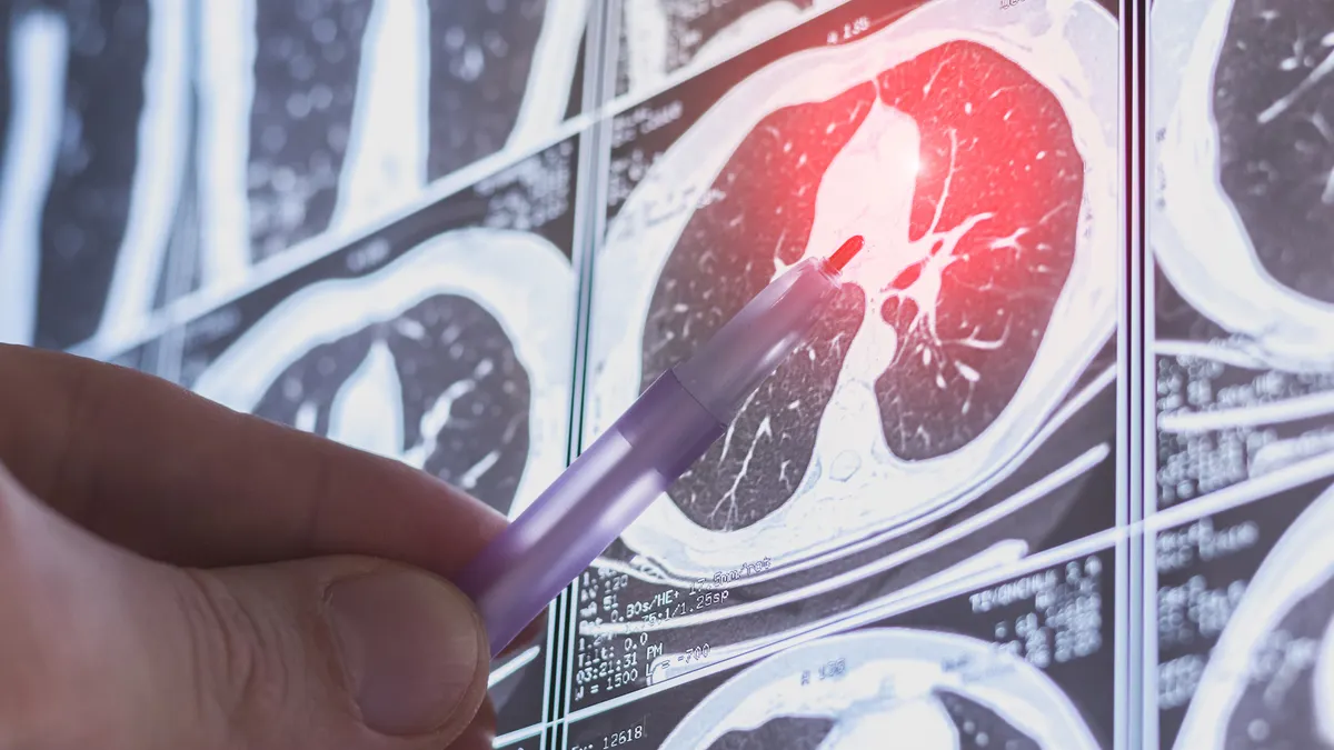 A person points to a CT scan of the lungs using a pen.