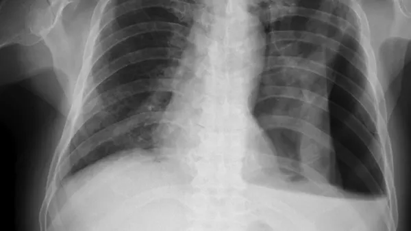 An X-ray image shows the lungs and the ribcage
