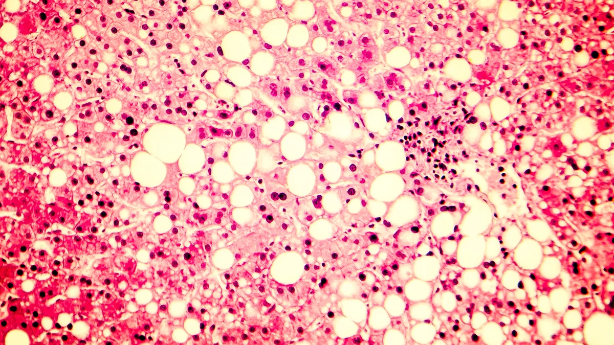 A micrograph showing triglyceride fat accumulated inside liver cells.