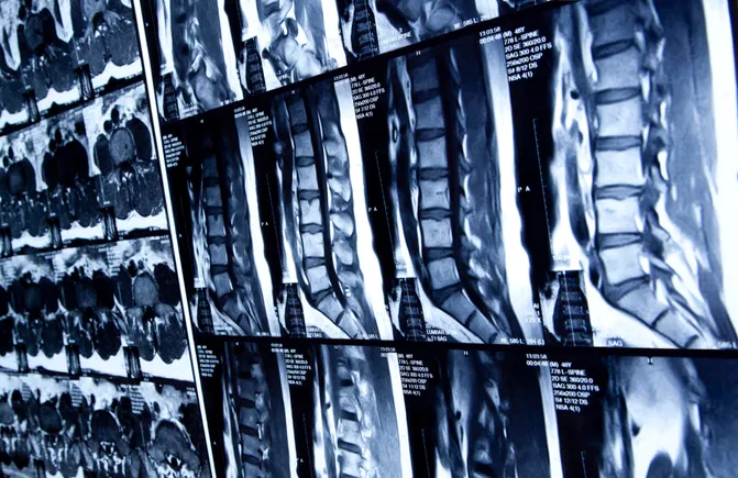 Stryker wins FDA clearance for minimally invasive back pain treatment