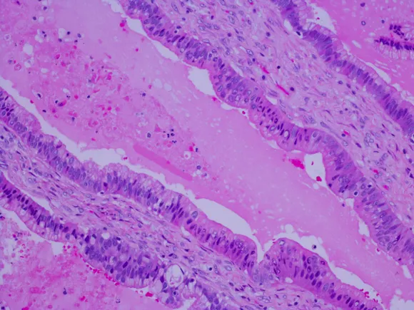 ‘Unprecedented’ Revolution data point to paradigm shift in pancreatic cancer