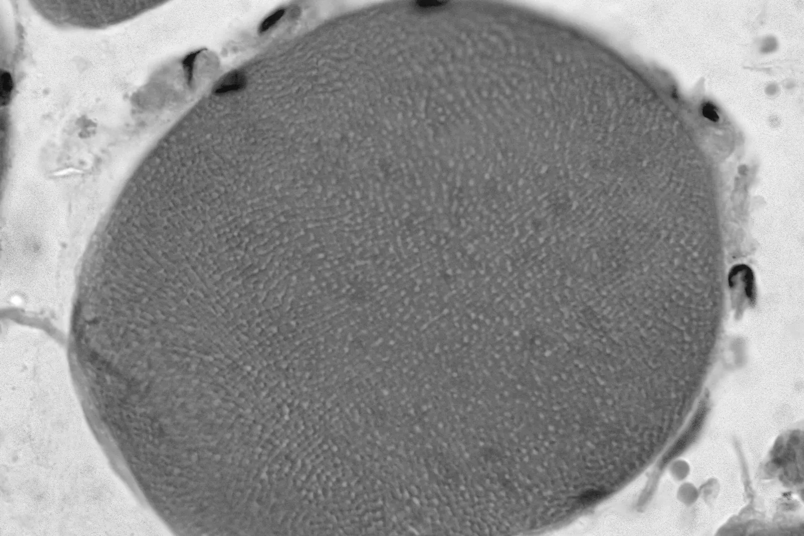 Necrotic muscle fiber associated with Duchenne muscular dystrophy