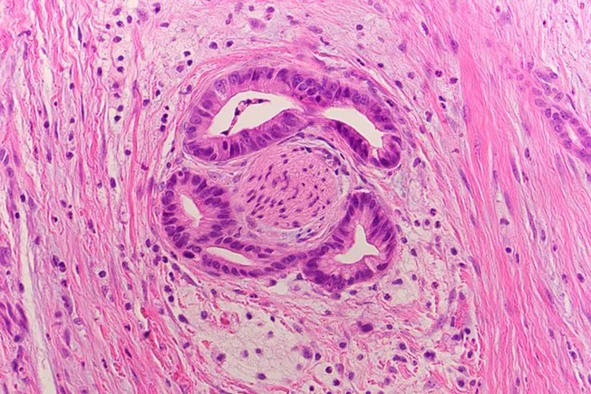 Revolution drug shows promise in early pancreatic cancer