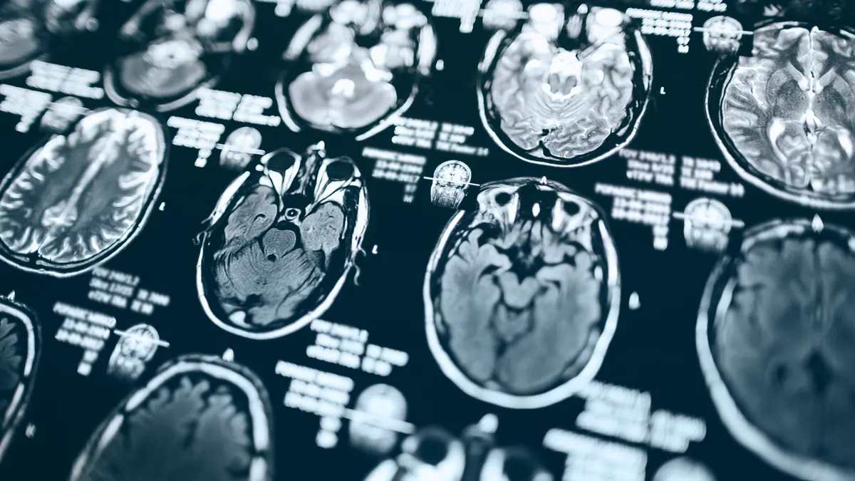 A human brain is imaged with a MRI scan.