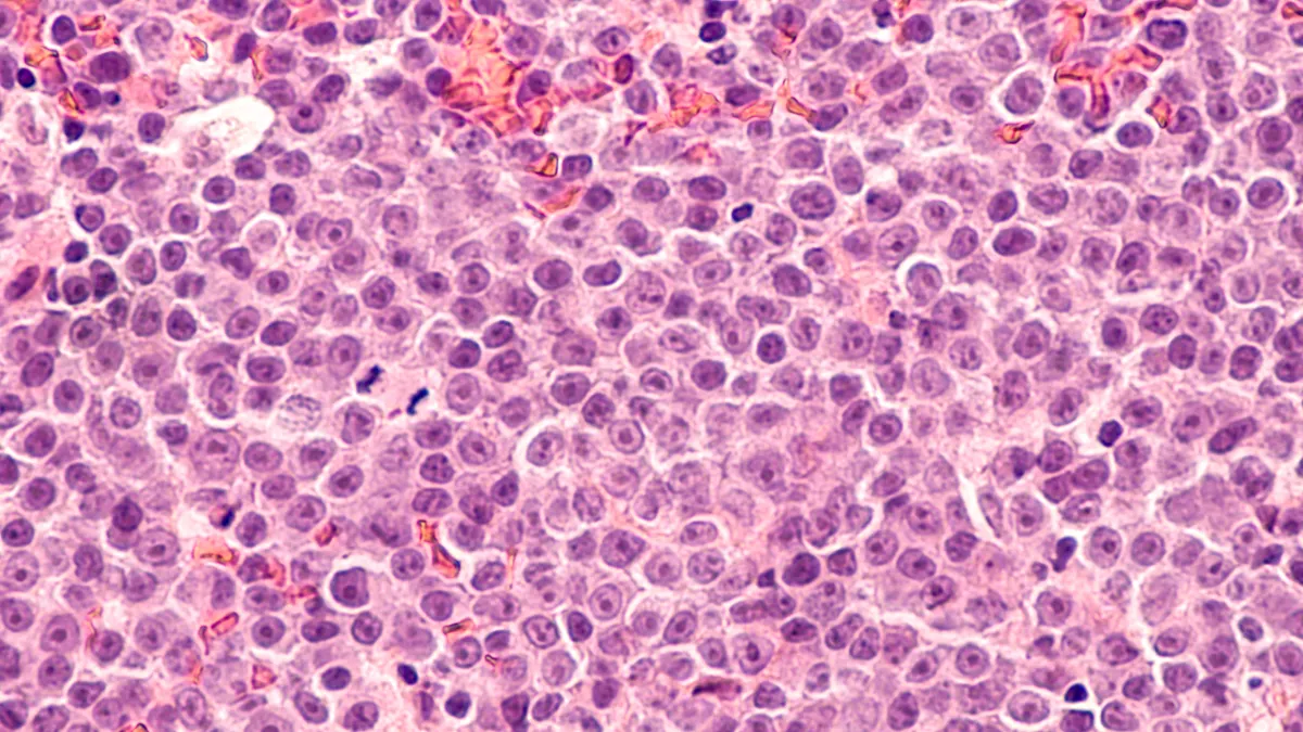 Photomicrograph of a diffuse large B-cell lymphoma (DLBCL) a type of non-Hodgkin lymphoma.