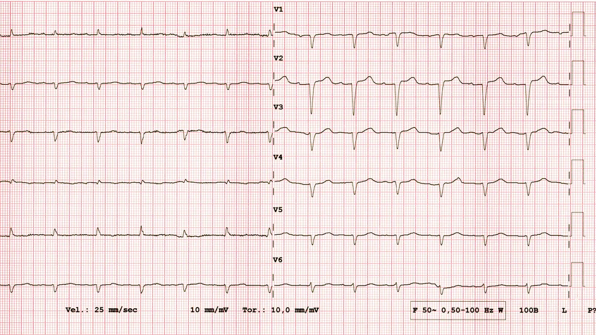 Six lines show heart rhythm patterns under the labels "v1, v2, v3, v4, v5, and v6."