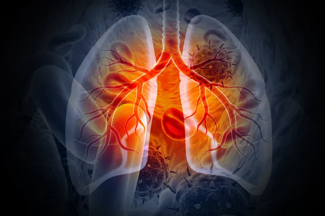 Chasing rivals, Nuvalent to seek approval of targeted lung cancer drug