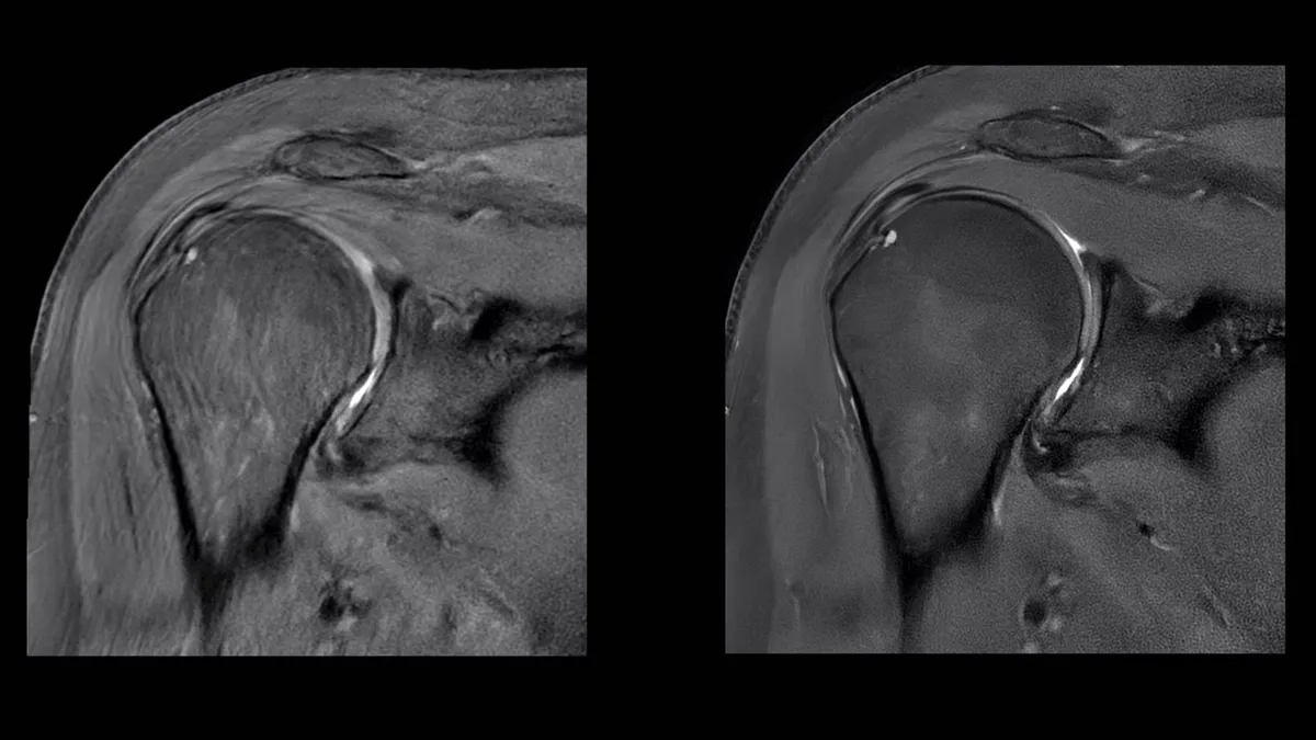 Two scans of a shoulder side by side. The image on the right is sharper.