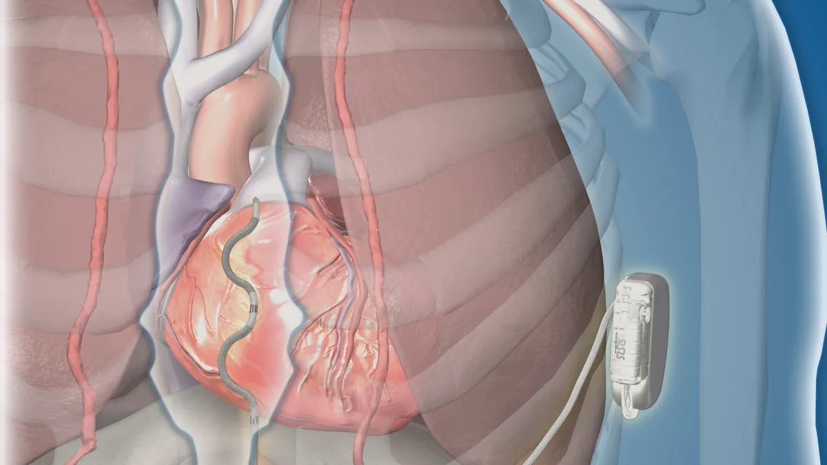 An illustration shows a small device placed outside of a person's ribcage, with a wire running under the sternum to their heart.