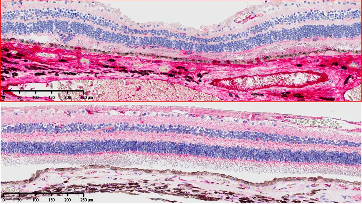 An image, illustrated in pink and purple, of bands of fibrin, a tough, insoluble protein found in the clotting of blood in abnormal versus normal levels of deposits.