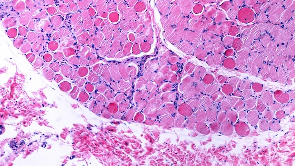 An illustration of necrotic muscle fiber in Duchenne muscular dystrophy.