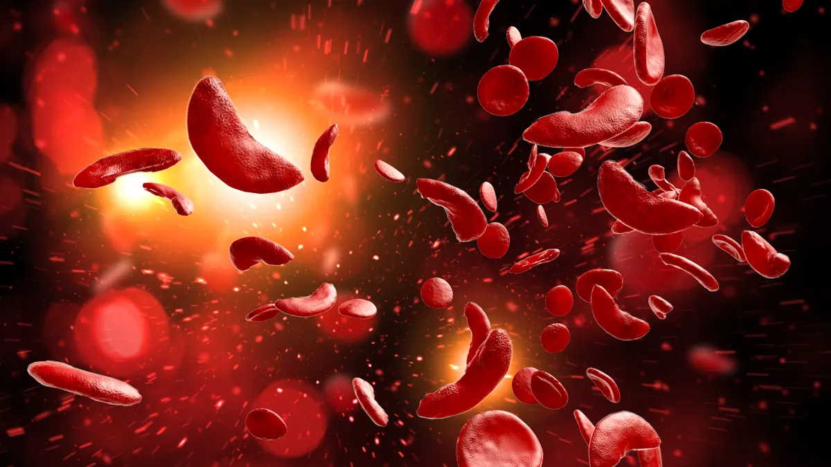 An illustration of sickled red blood cells.