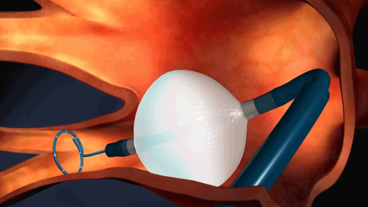 Arctic Front Advance™ Cardiac Cryoablation System from Medtronic to treat drug-resistant arrhythmia