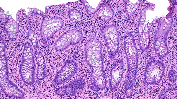 Light micrograph of crypt architectural distortion in inflammatory bowel disease.
