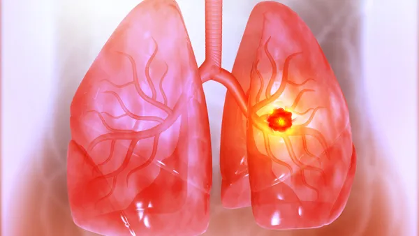 An illustration of a cancerous tumor inside the lungs