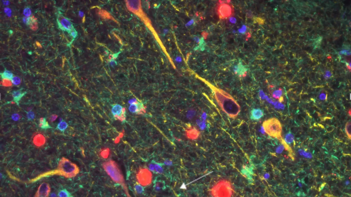 In this image of Alzheimer’s brain tissue, gingipains from the bacteria P. gingivalis are red;  MAP2, a marker of neurons, is yellow; and GFAP, a marker of glial cells surrounding neurons,  is green.