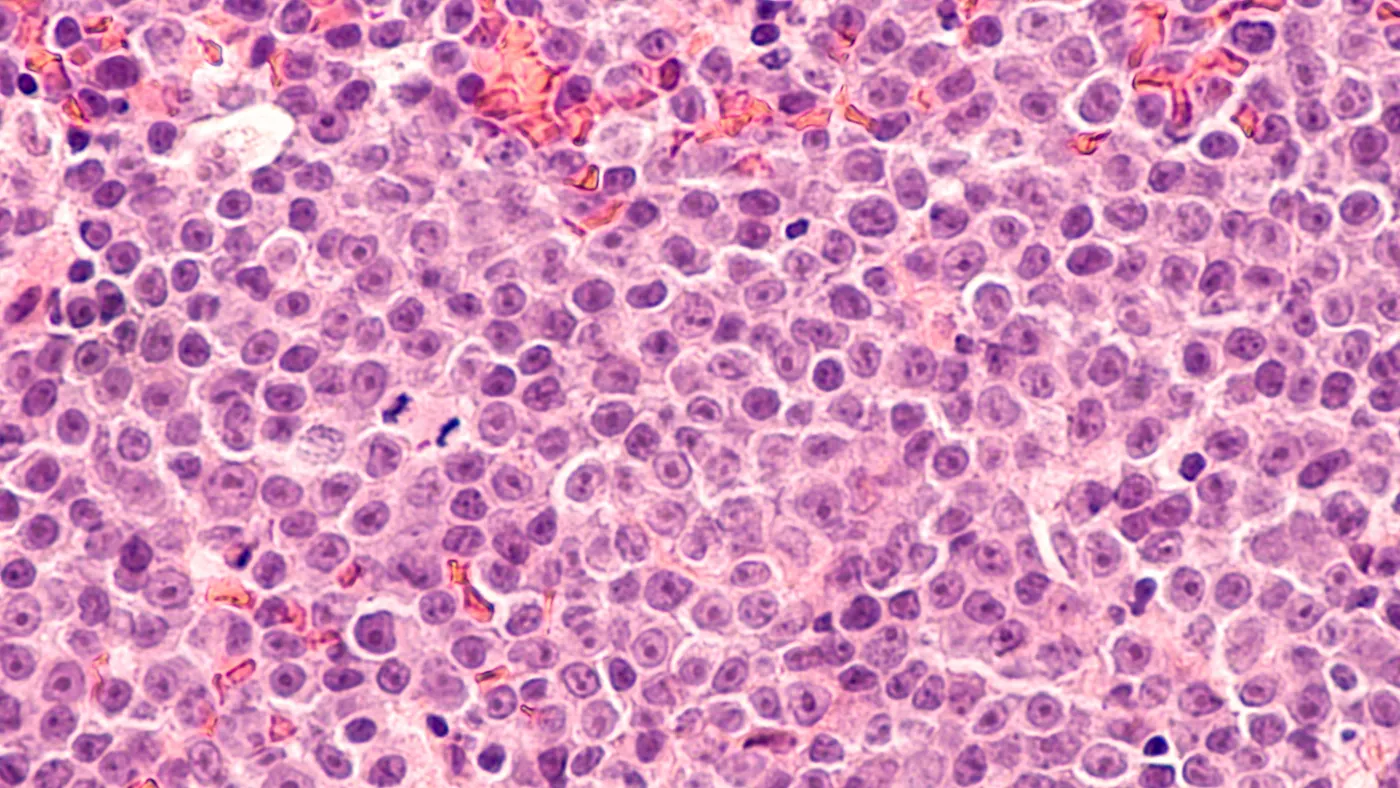 Photomicrograph of a diffuse large B-cell lymphoma (DLBCL) a type of non-Hodgkin lymphoma.
