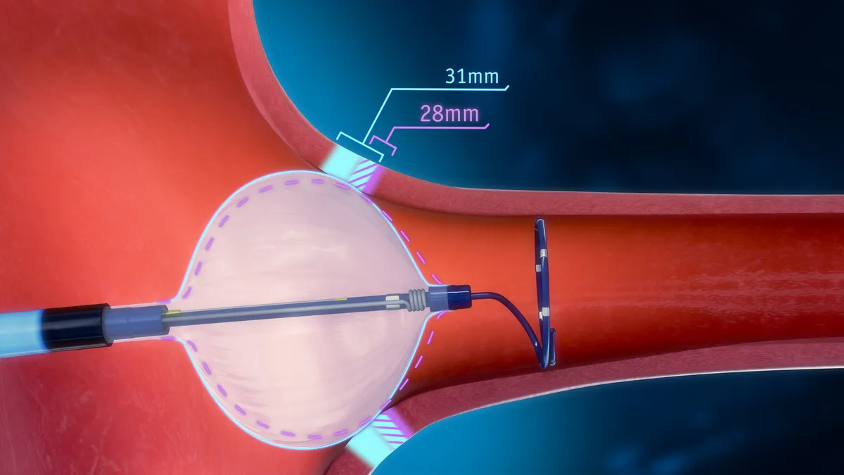 A device with a loop on the end and a white balloon is in a blood vessel.