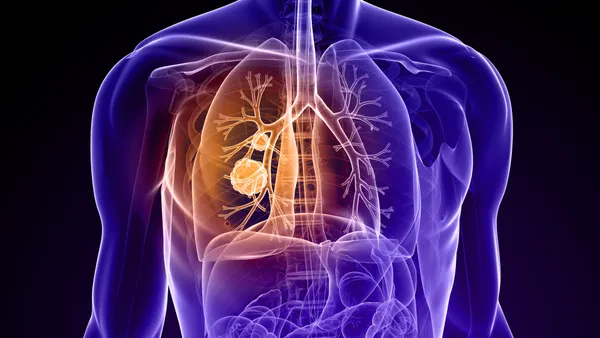 Illustration of lung cancer