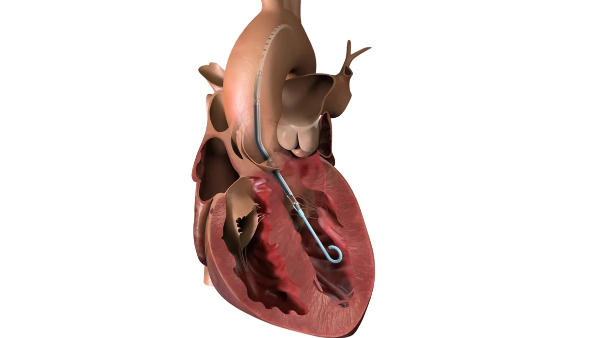 illustration of a heart showing a tube-shaped device going into the left ventricle