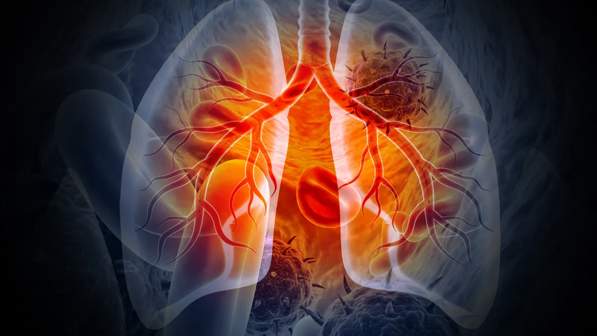 A medical Illustration showing lung cancer or bronchial carcinoma.