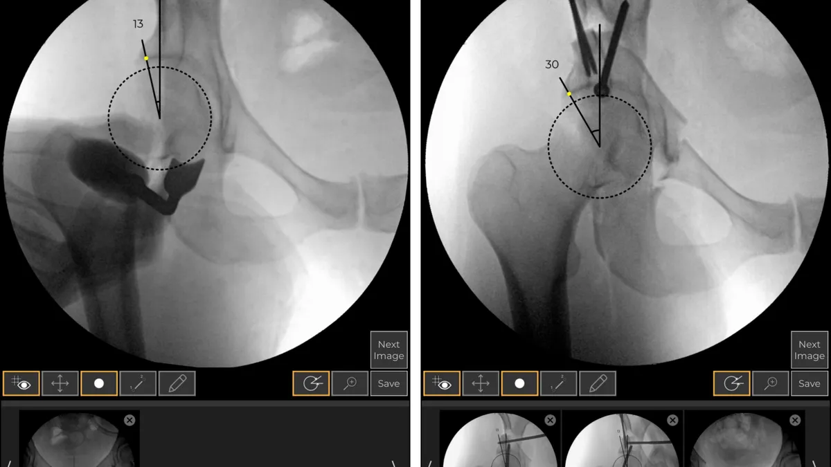 An x-ray image shows a hip bone with an overlay showing an angle.