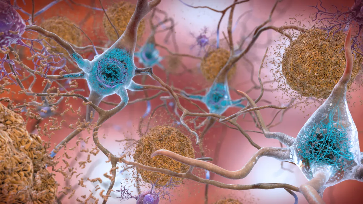 An illustration of beta amyloid plaques and tau in the brain