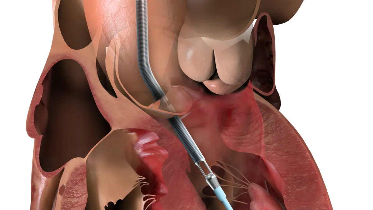 An illustration of an Abiomed heart pump