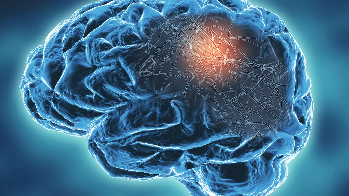 A neurodegenerative disease concept illustration