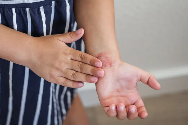 Chasing Dupixent, a biotech aims to make better antibody drugs for eczema
