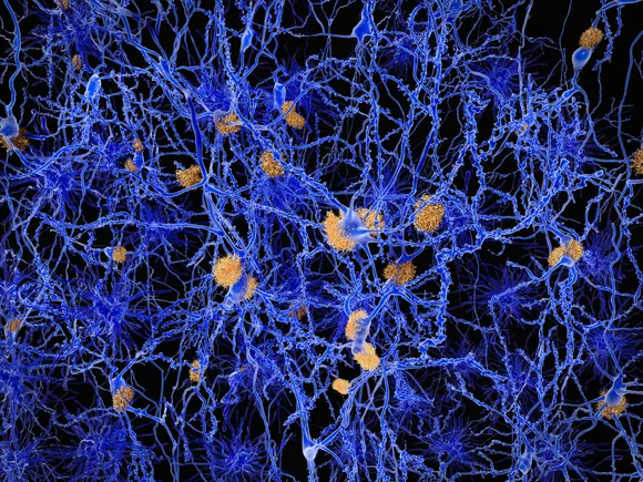 NewAmsterdam says cholesterol drug may also combat Alzheimer’s