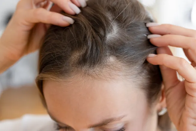 Veradermics keeps ‘momentum going’ as baldness drug helps women with hair loss