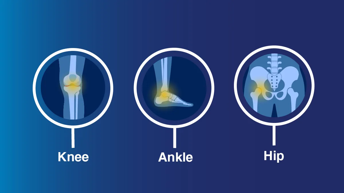 image of the joints recalled by Exatech