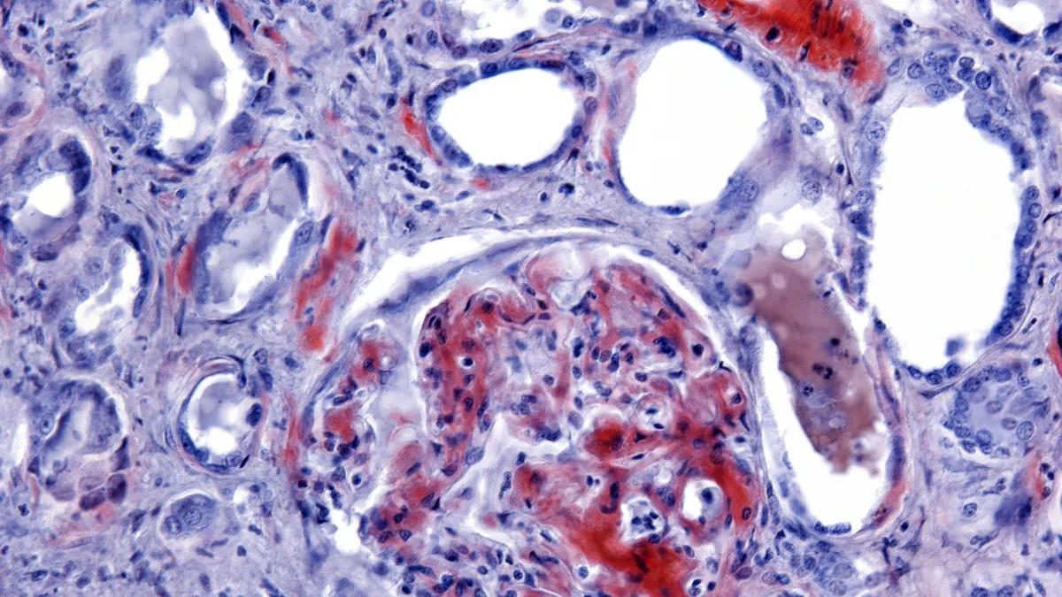 A micrograph of amyloidosis in a human kidney showing amyloid stained with Congo red in the glomeruli and wall of blood vessels.
