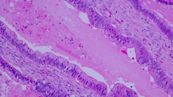 Pancreatic cancer cells are stained pink in this micrograph image.