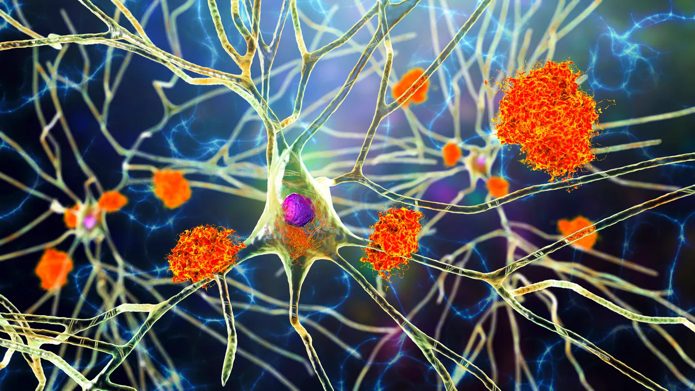 A 3D illustration showing amyloid plaques in brain tissue