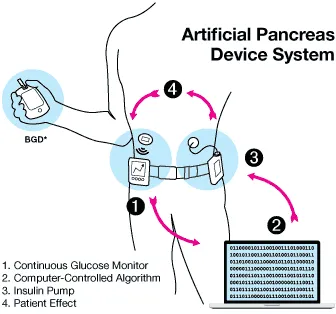 A chart showing a person wearing a continuous glucose monitor, which sends information to a computer and then an insulin pump.