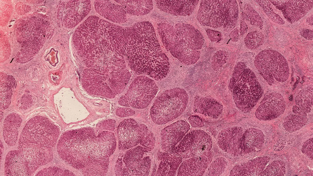 An image of liver cirrhosis