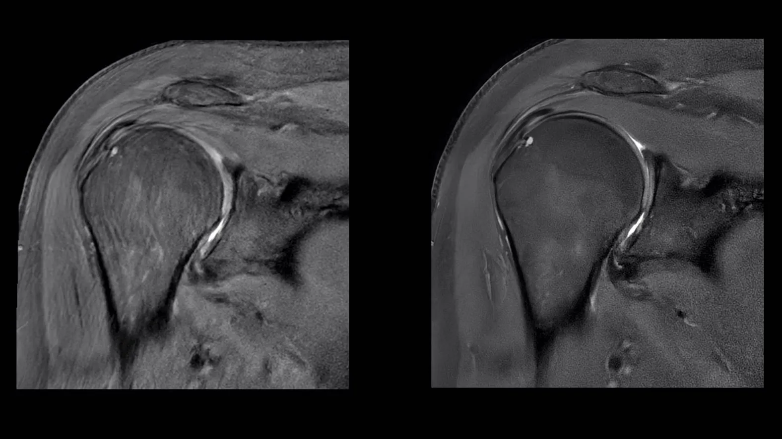 Two x-rays of a shoulder side by side.