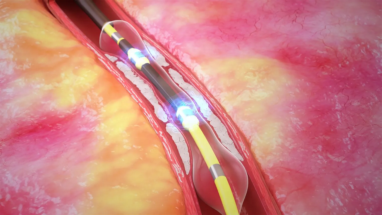 A  ShockWave sonic catheter